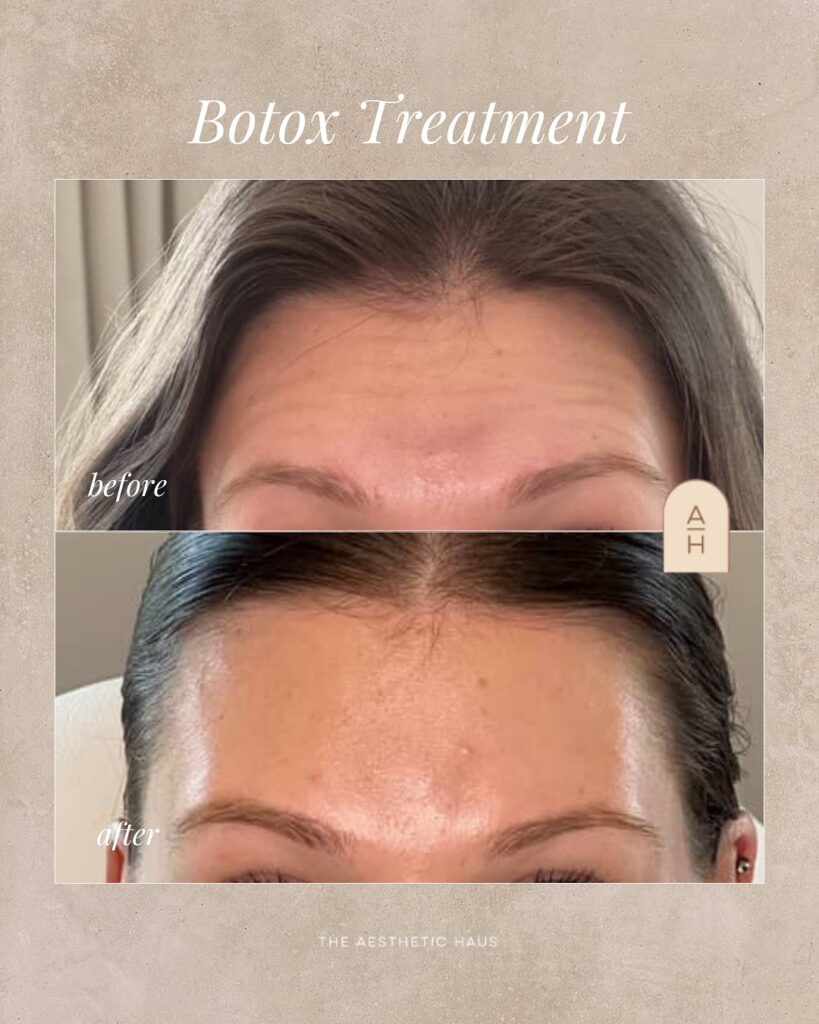 Botox Before and After Kernersville