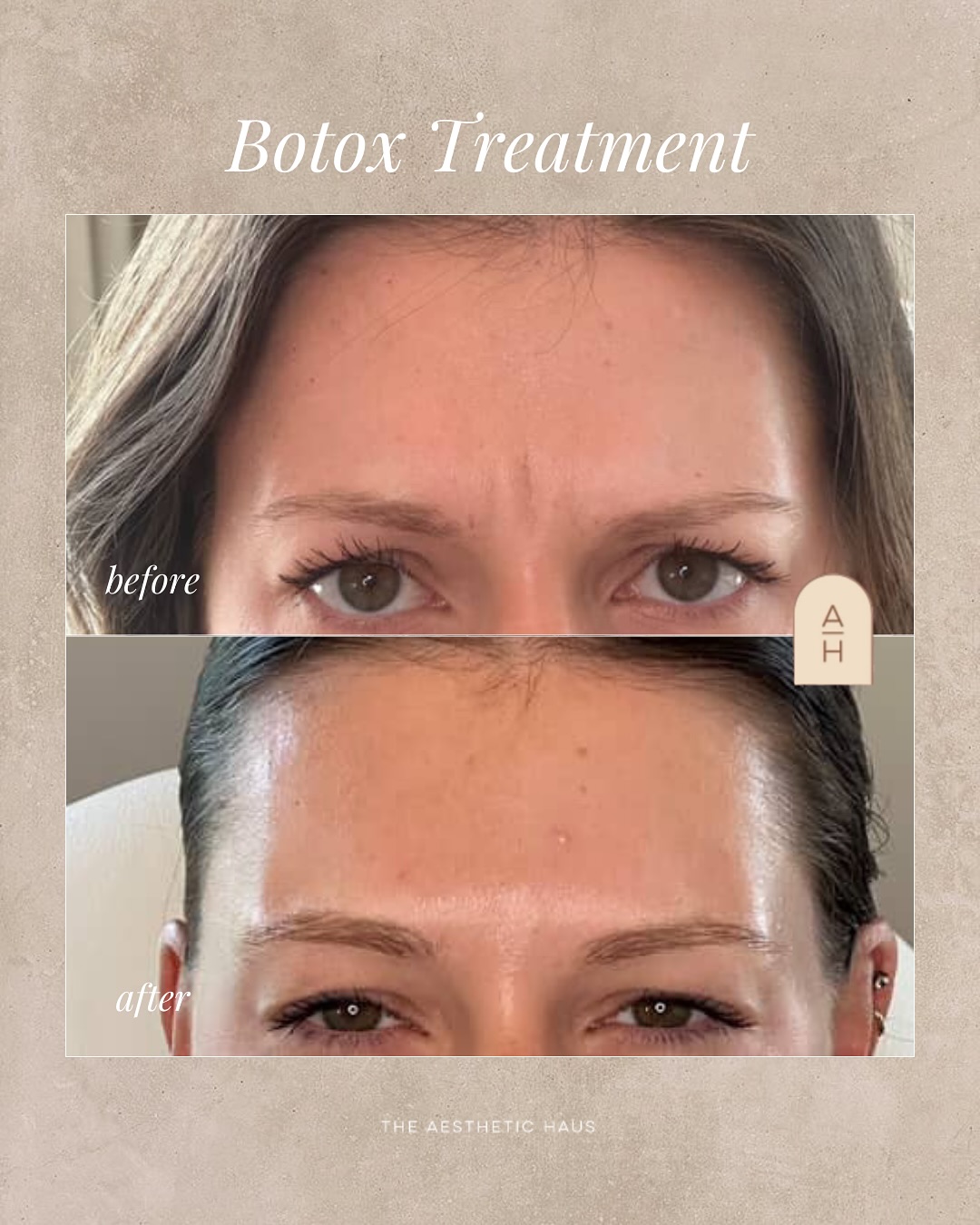 Botox Results